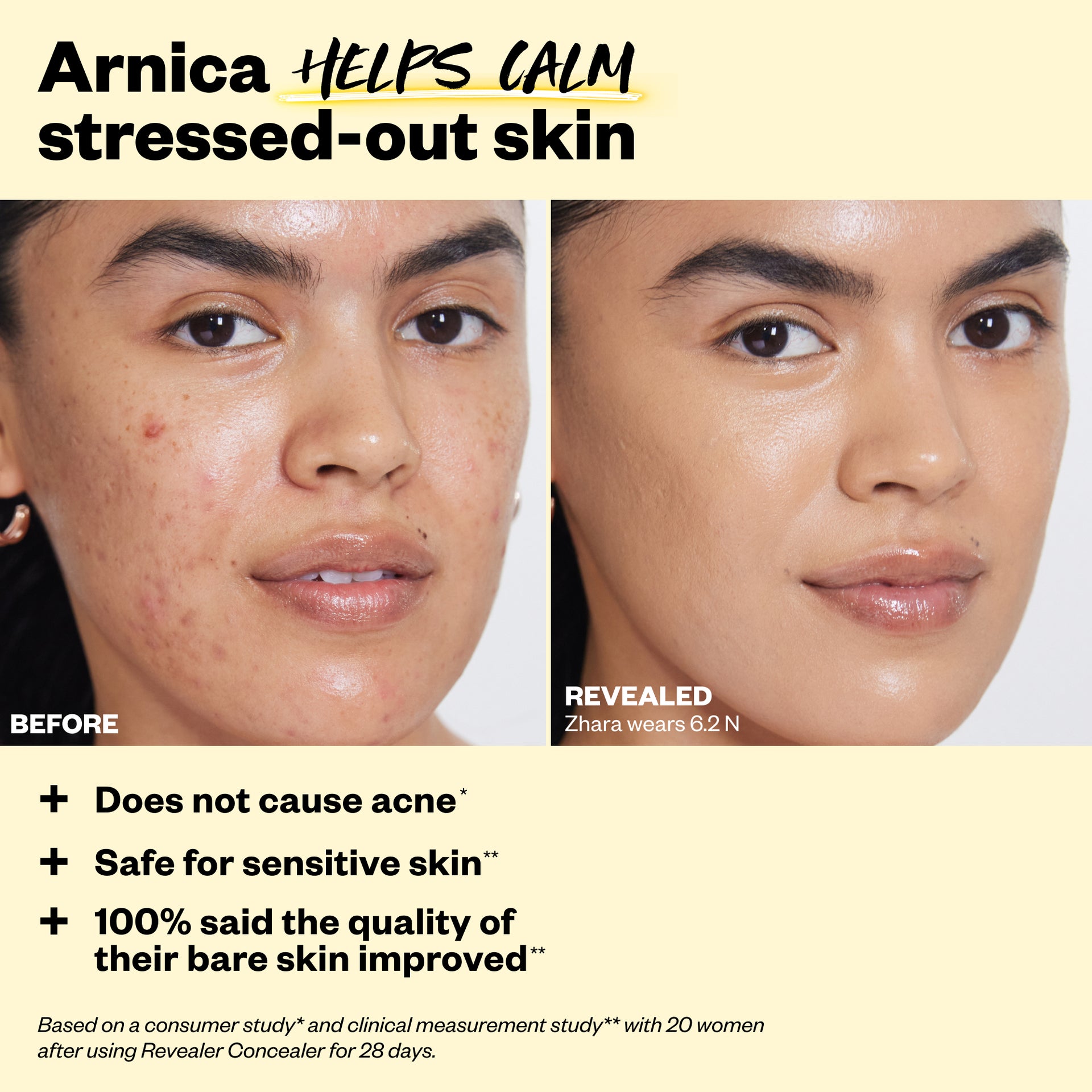 Arnica helps calm stressed-out skin. Does not cause acne, safe for sensitive skin, 100% said the quality of their bare skin improved.